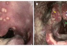 Santé sexuelle en péril: La résistance de la gonorrhée aux médicaments clés atteint des seuils critiques