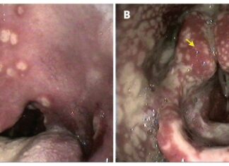 Santé sexuelle en péril: La résistance de la gonorrhée aux médicaments clés atteint des seuils critiques