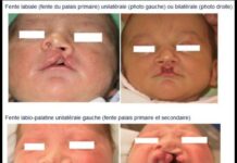 Bénin/Prise en charge des fentes et des brûlures: La chirurgie plastique au service de l’humain