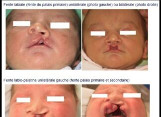 Bénin/Prise en charge des fentes et des brûlures: La chirurgie plastique au service de l’humain