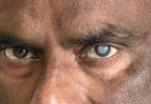 Cataracte: Le droit de voir, un privilège encore trop géographique