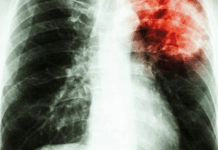 Vers la fin de la tuberculose: Cap sur l’innovation et le leadership communautaire